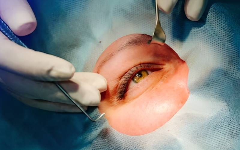 Breaking Down The Cost Of Lasik Surgery: What You Need To Know?