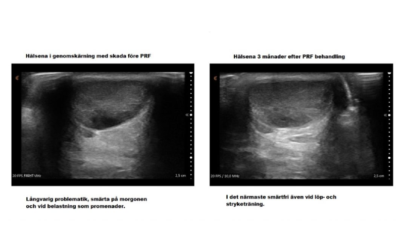 prp behandling stockholm