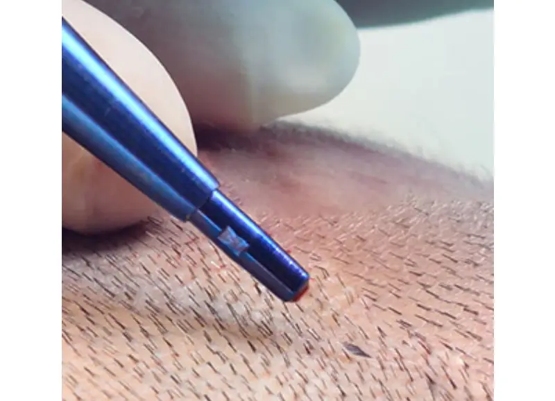 Hair Transplant in Istanbul
