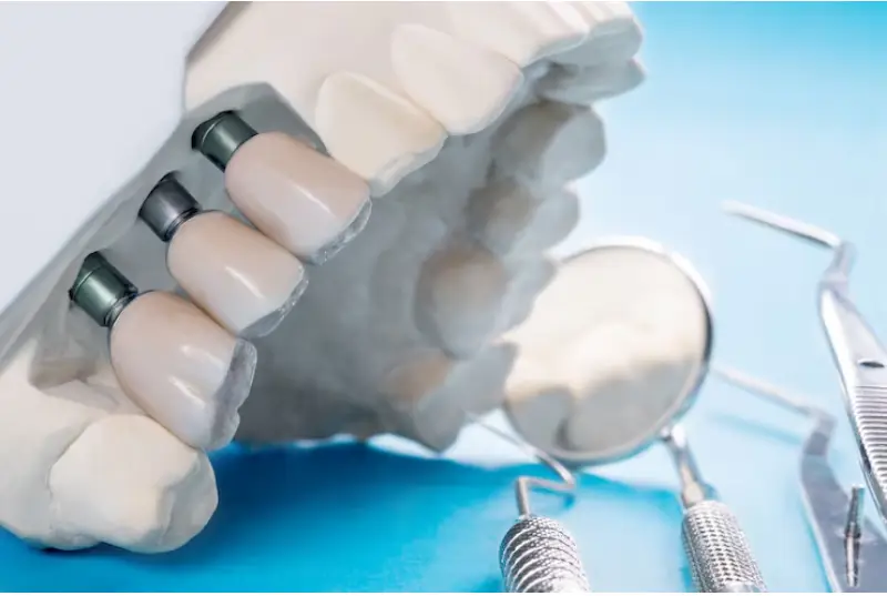 All on 4 dental implants pembroke pines