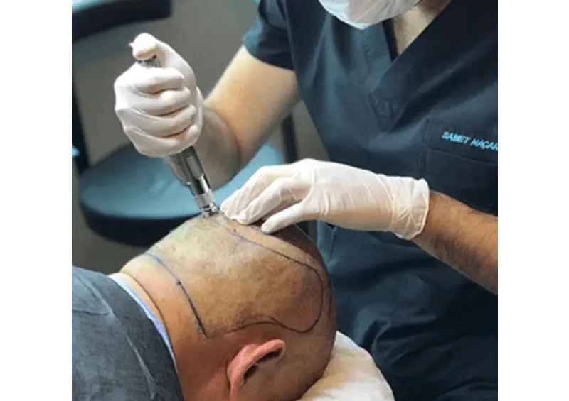 Hair Transplant in Istanbul 