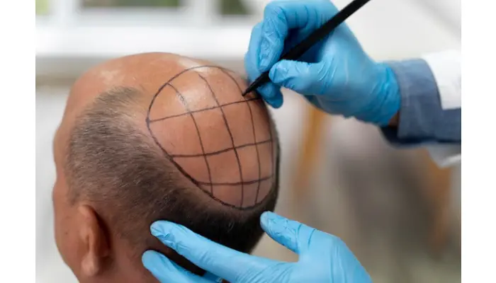 How to Prepare for Your Hair Transplant Trip to Turkey?