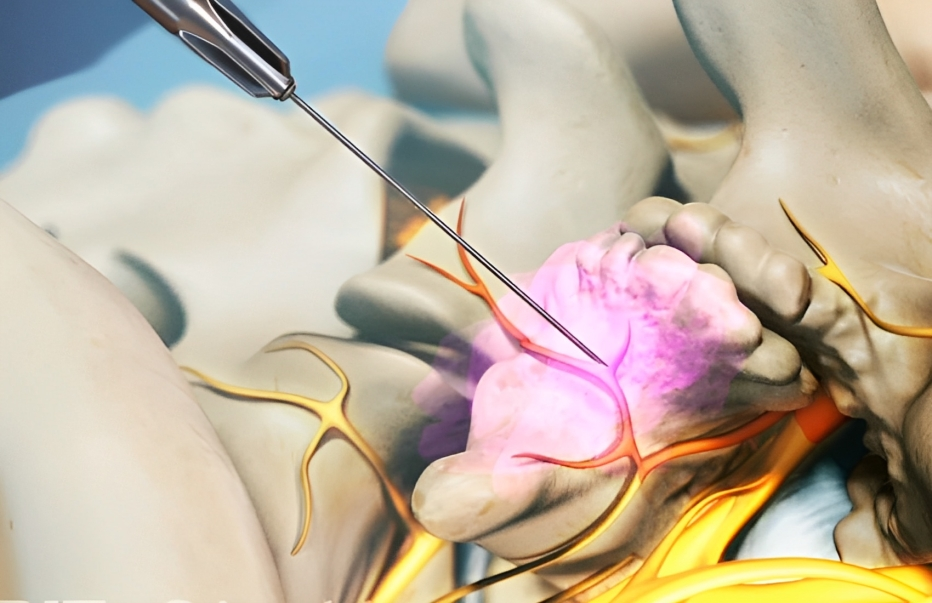medial branch nerve block