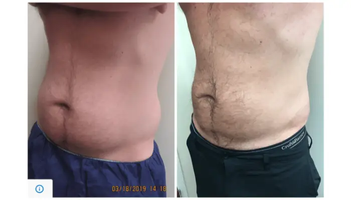 Liposuction In Washington DC: What You Need To Know Before Your Procedure?