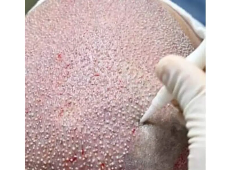 How Hair Transplant In Istanbul Can Boost Your Confidence?