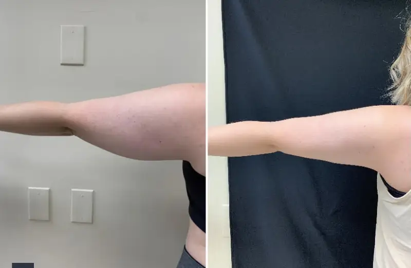 Laser Lipo In DC: Transform Your Body With Advanced Technology