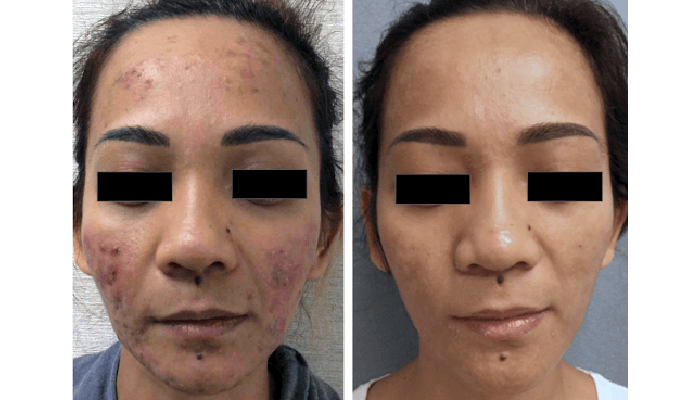 Hyperpigment Laser Treatment For Acne Scars And Dark Spots