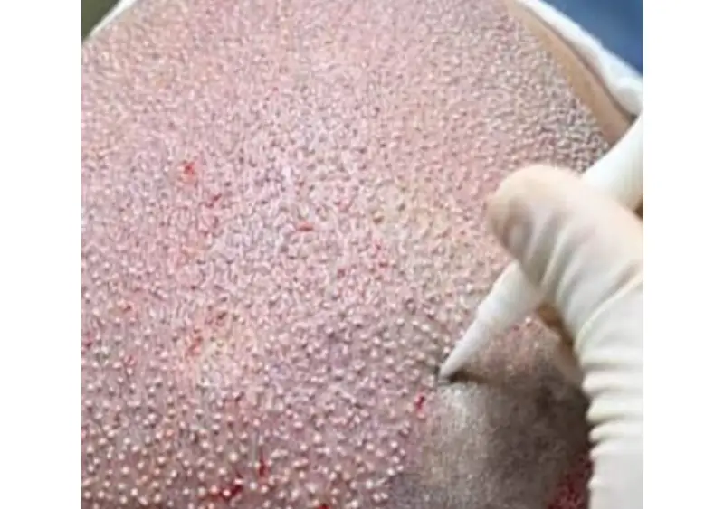 Why Choose Istanbul for Hair Transplant Procedures?