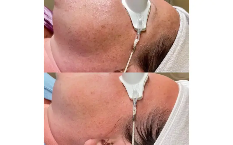 understanding Melasma Laser Treatment